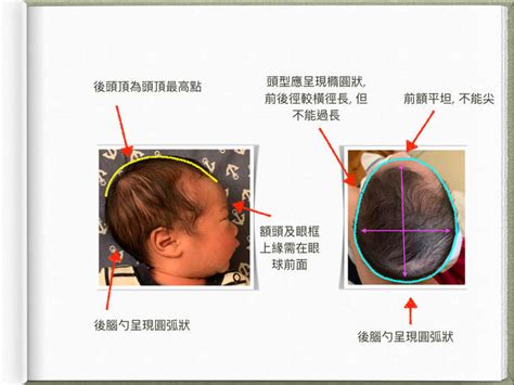 嬰兒額頭突出|【盧亭辰醫師】寶寶頭型怪怪的，會是顱縫早閉症嗎？。